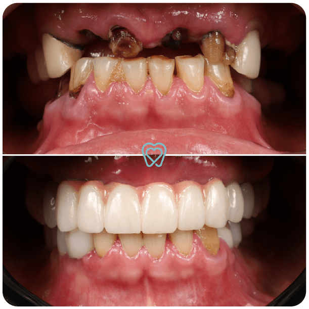 all on 4 dental implants in tijuana mexico