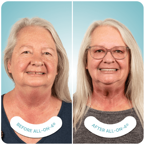 all on 4 dental implants in tijuana mexico
