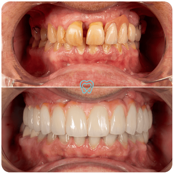 all on 4 dental implants in tijuana mexico