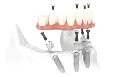 The Power of All-on-4®: How Dental Implants in Tijuana Can Change Your Life
