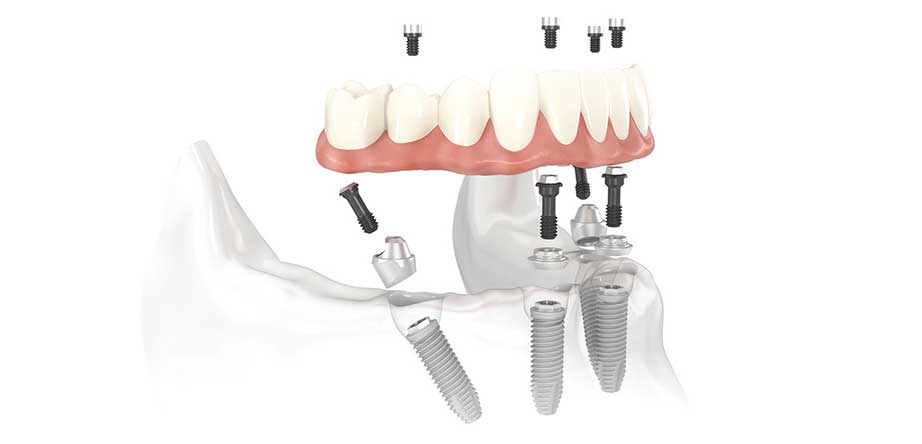 The Power of All-on-4®: How Dental Implants Can Change Your Life