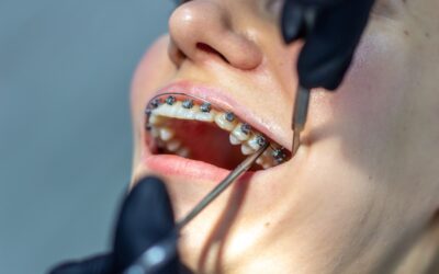 Can Adults Get Braces? Exploring Orthodontic Treatment for All Ages