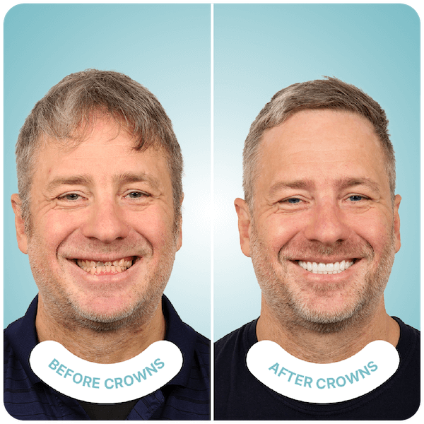 Dental Crowns - Perfect Smile