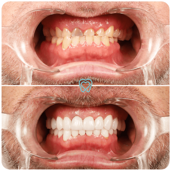 Dental Crowns with natural shape