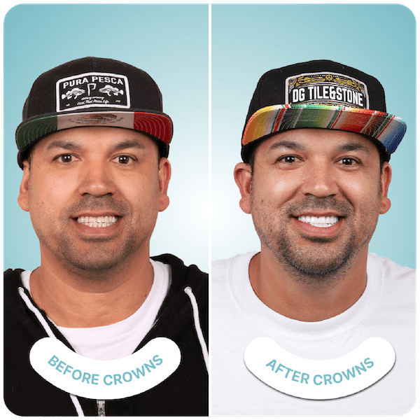 Best Dental Crowns - Dentist in Tijuana