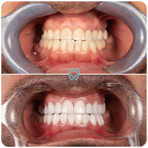 Dental Crowns - Dentist in Mexico