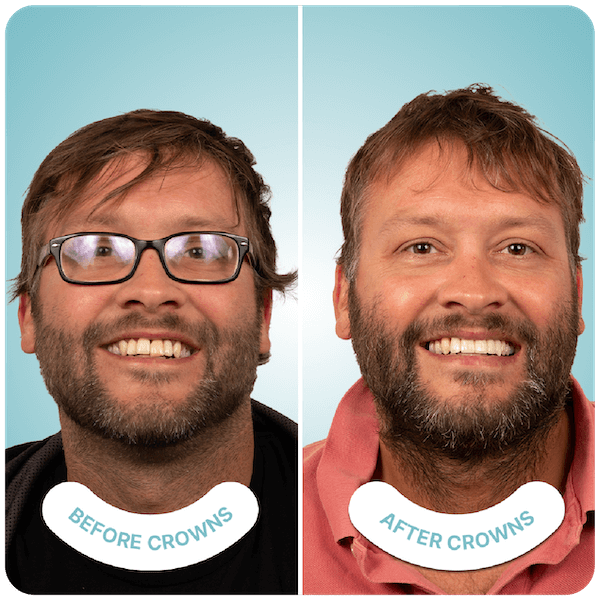 best crowns dentist in tijuana