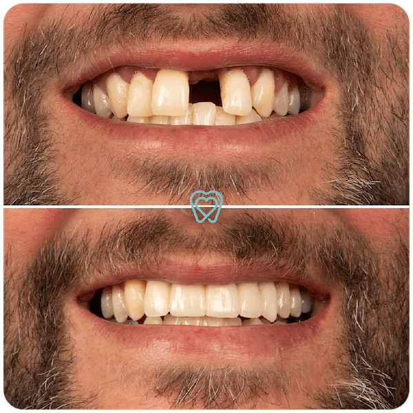 best crowns dentist in tijuana