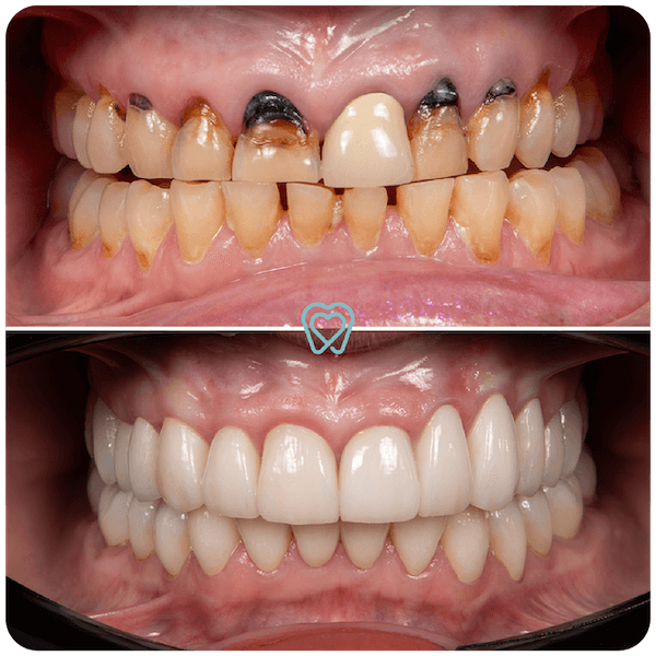 best crowns dentist in tijuana
