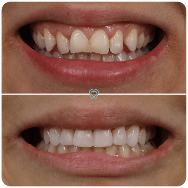 Dental Veneers in Tijuana Mexico - I love my dentist Dental Veneers in Tijuana Mexico - I love my dentist