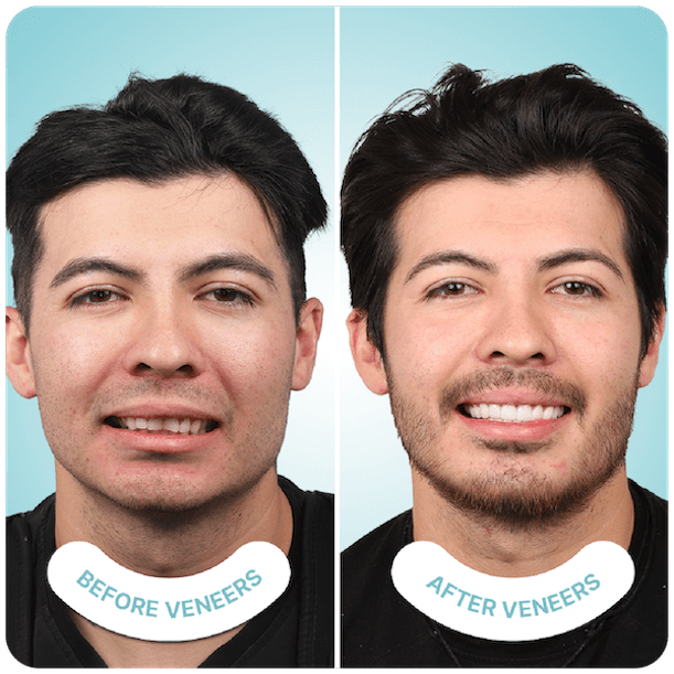 Best Dental Veneers in Mexico - I love my dentist Best Dental Veneers in Mexico - I love my dentist