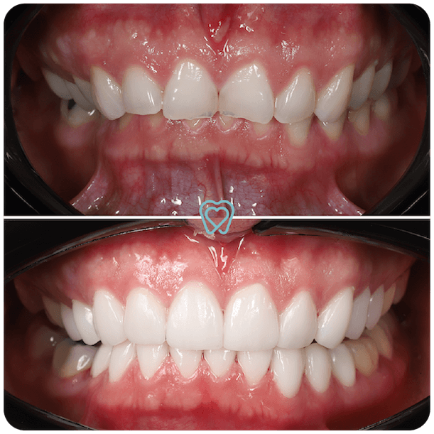 Veneers in Tijuana - I love my dentist Veneers in Tijuana - I love my dentist