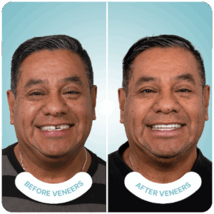 best veneers in tijuana
