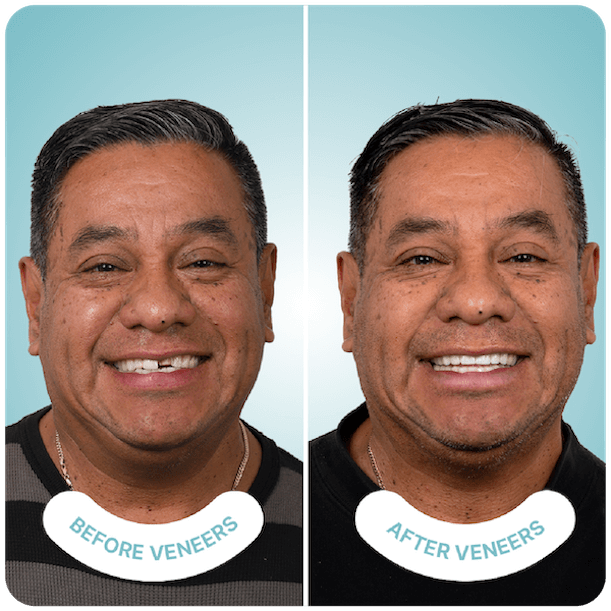 best veneers in tijuana best veneers in tijuana