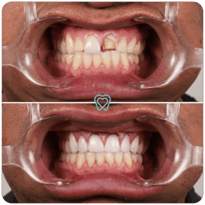 best veneers in tijuana