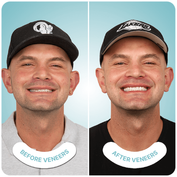 best veneers in tijuana best veneers in tijuana