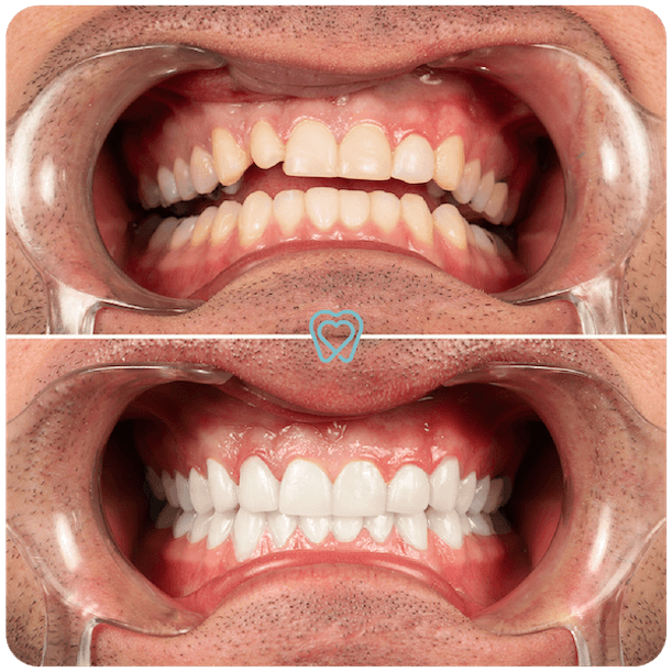 best veneers in tijuana best veneers in tijuana