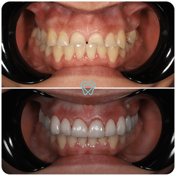 Veneers for a Confident Smile Veneers for a Confident Smile