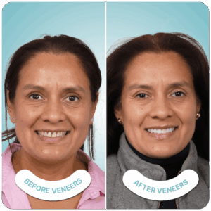 best veneers in tijuana