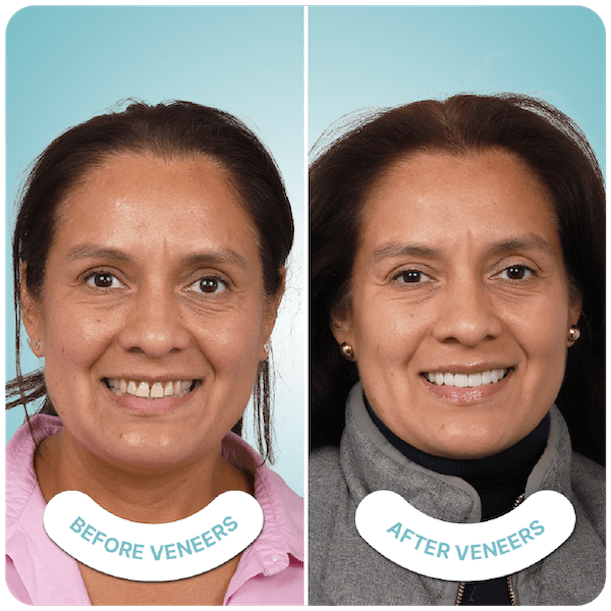 Best Veneers in Tijuana Mexico Best Veneers in Tijuana Mexico