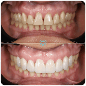 best veneers in tijuana