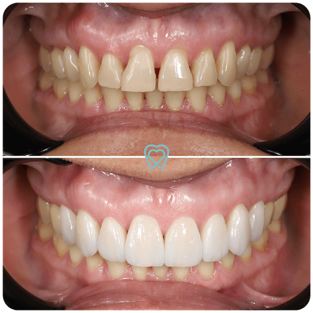 Veneers in Tijuana Veneers in Tijuana