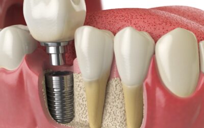 Zirconia and Acrylic Dental Implants: Features and Benefits You Should Know