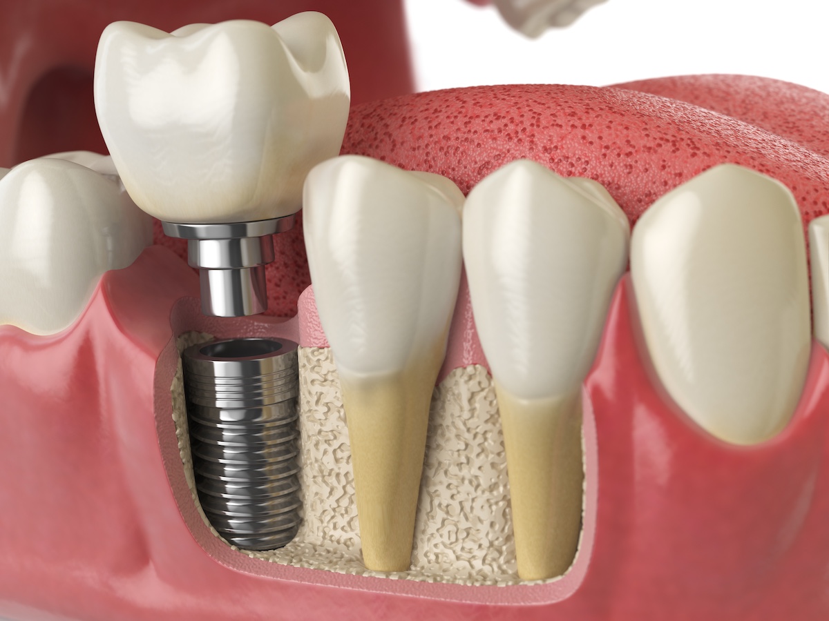Zirconia and Acrylic Dental Implants: Features and Benefits You Should Know