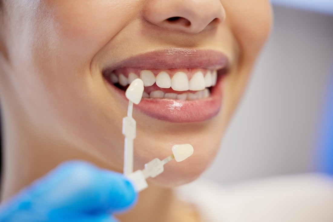 Dental Crowns Cost: Why Patients Choose I Love My Dentist in Tijuana