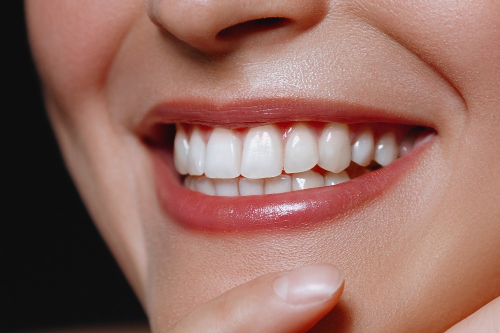 How Much Do Veneers Cost in Tijuana