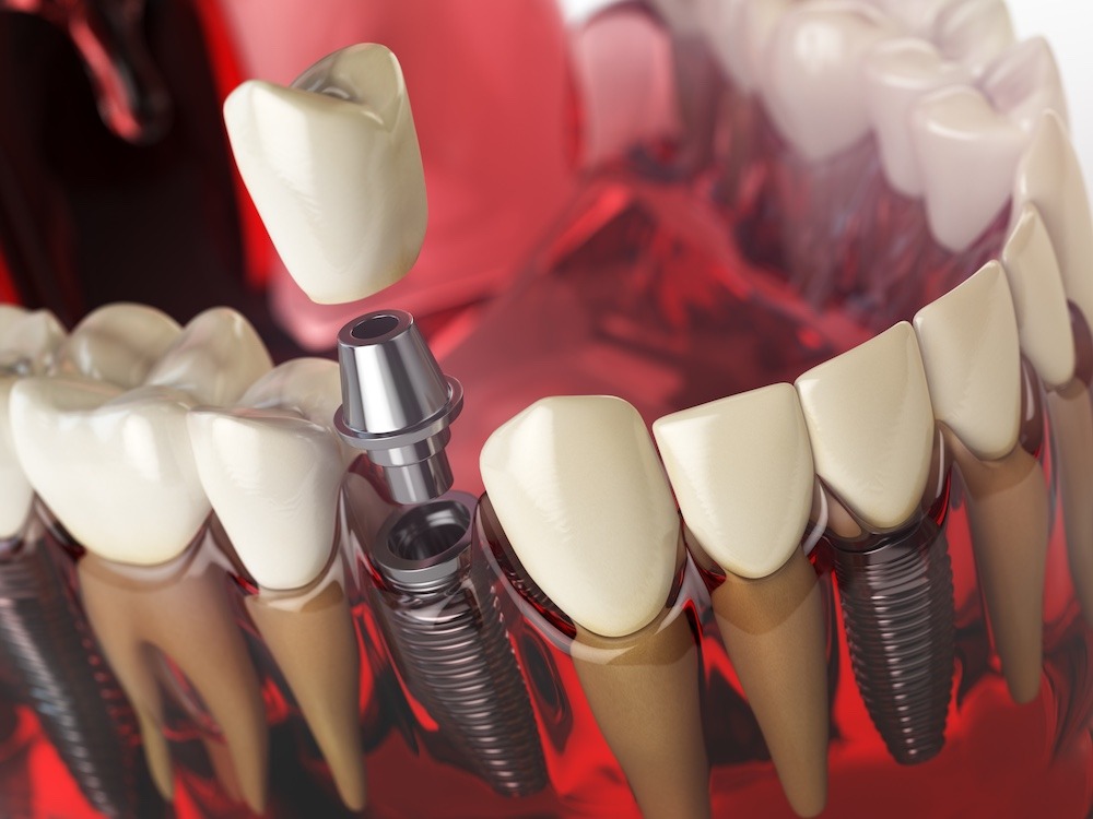 Full Mouth Dental Implants Cost in Mexico 2025 Savings Guide