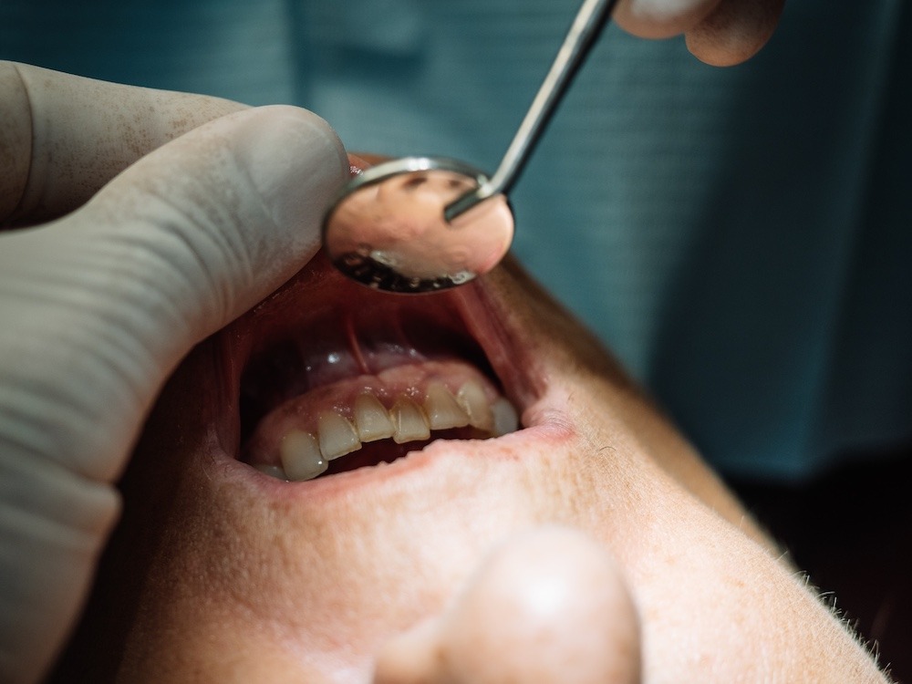 tooth abscess treatment in Tijuana