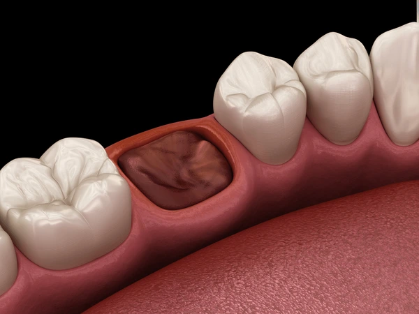 Severe Dry Socket Pain? Symptoms, Pictures & Treatment Guide